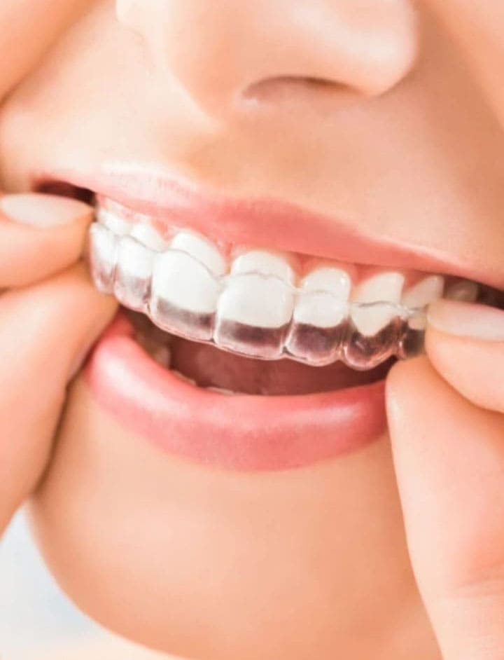 Una persona poniéndose un alineador en los dientes.